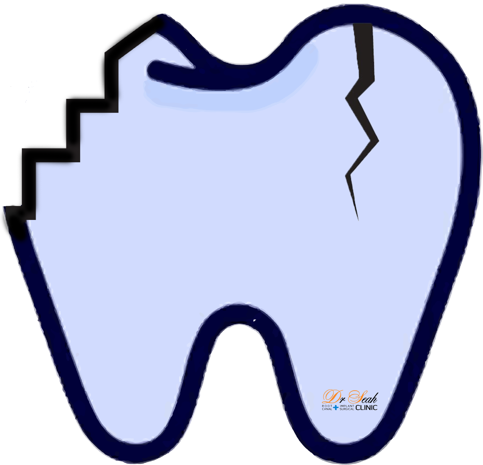 Tooth Discolouration