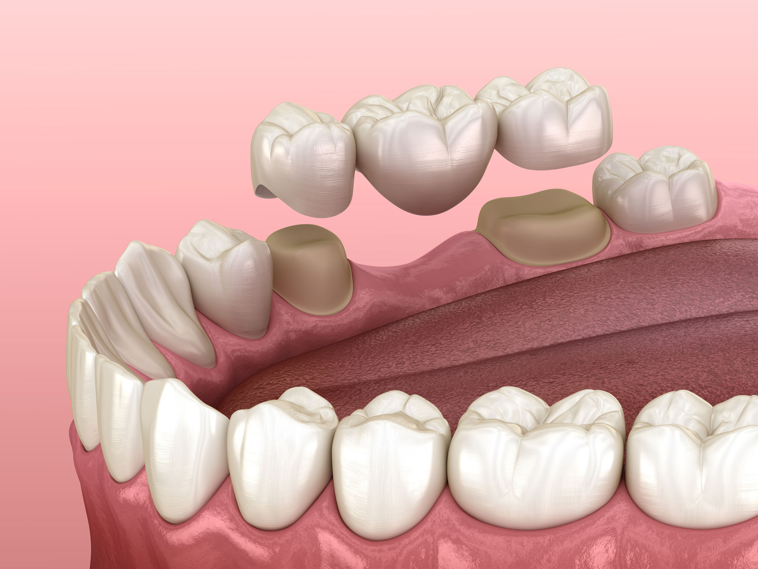 Dental Bridge Singapore Demonstration