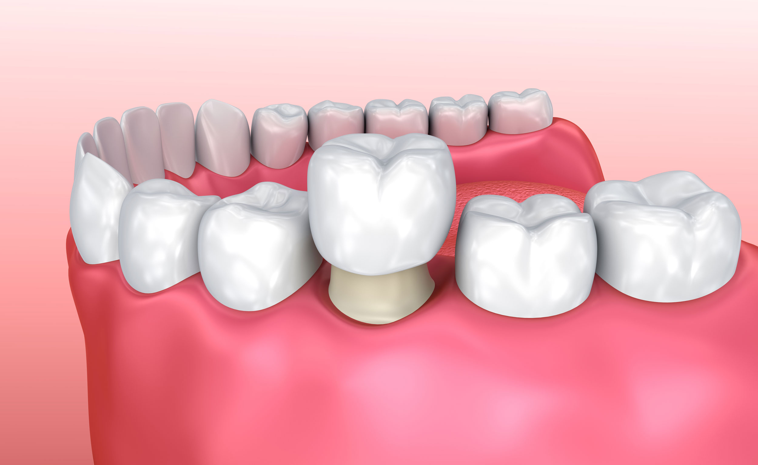 Dental Crown Replacement Aftercare Singapore