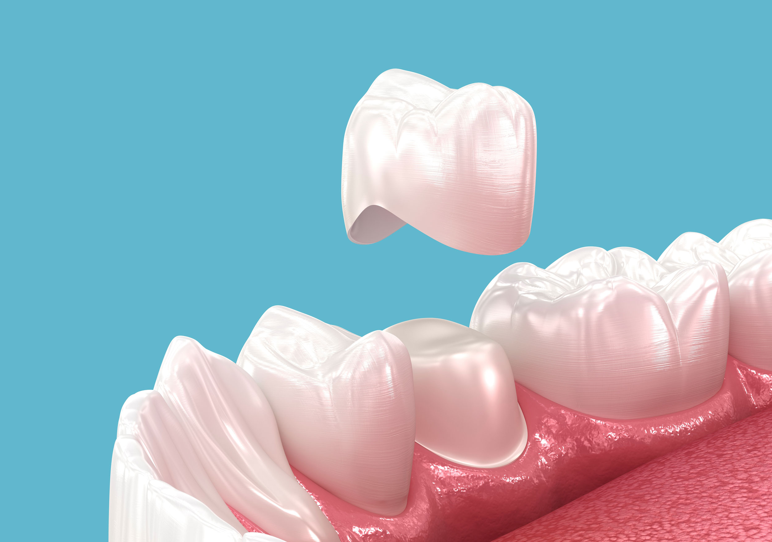 Dental Crown Replacement Procedure