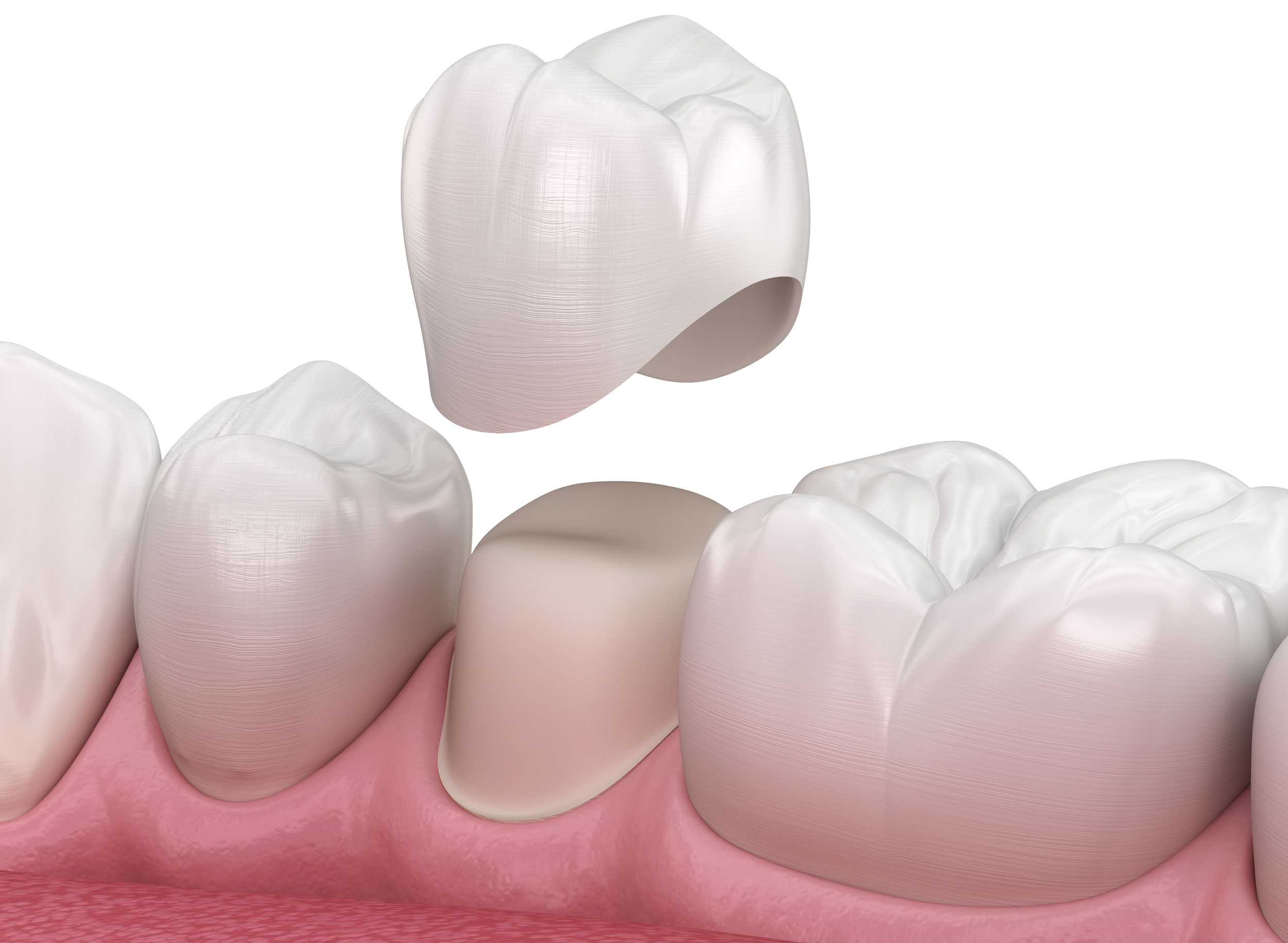 Evaluating Dental Crowns