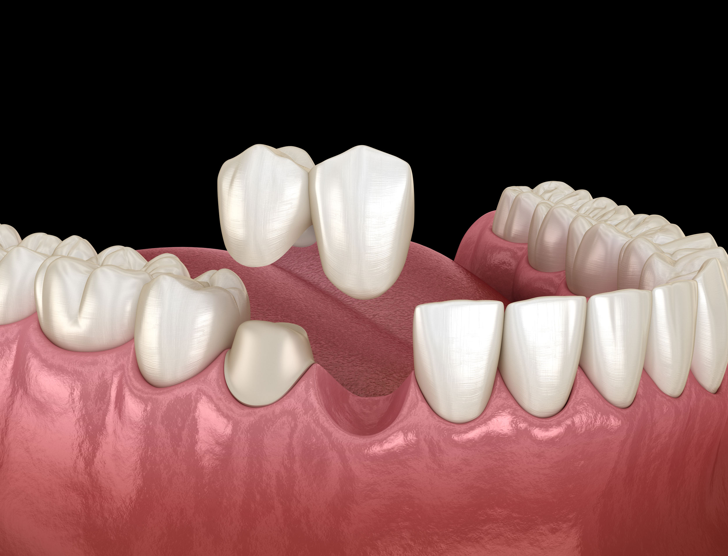 Fixed Dental Bridge Fitting Procedure
