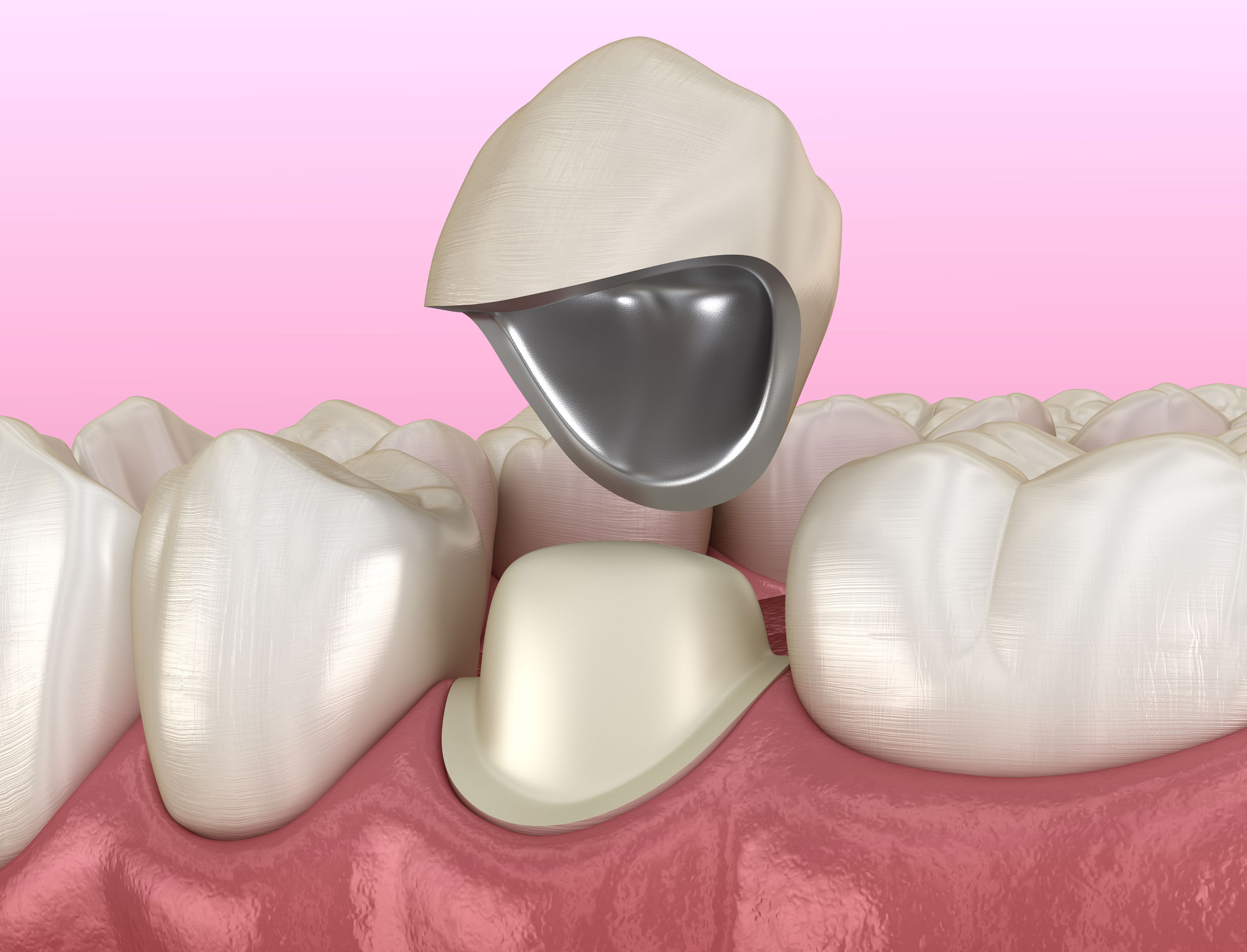 Teeth Crowning Evaluation