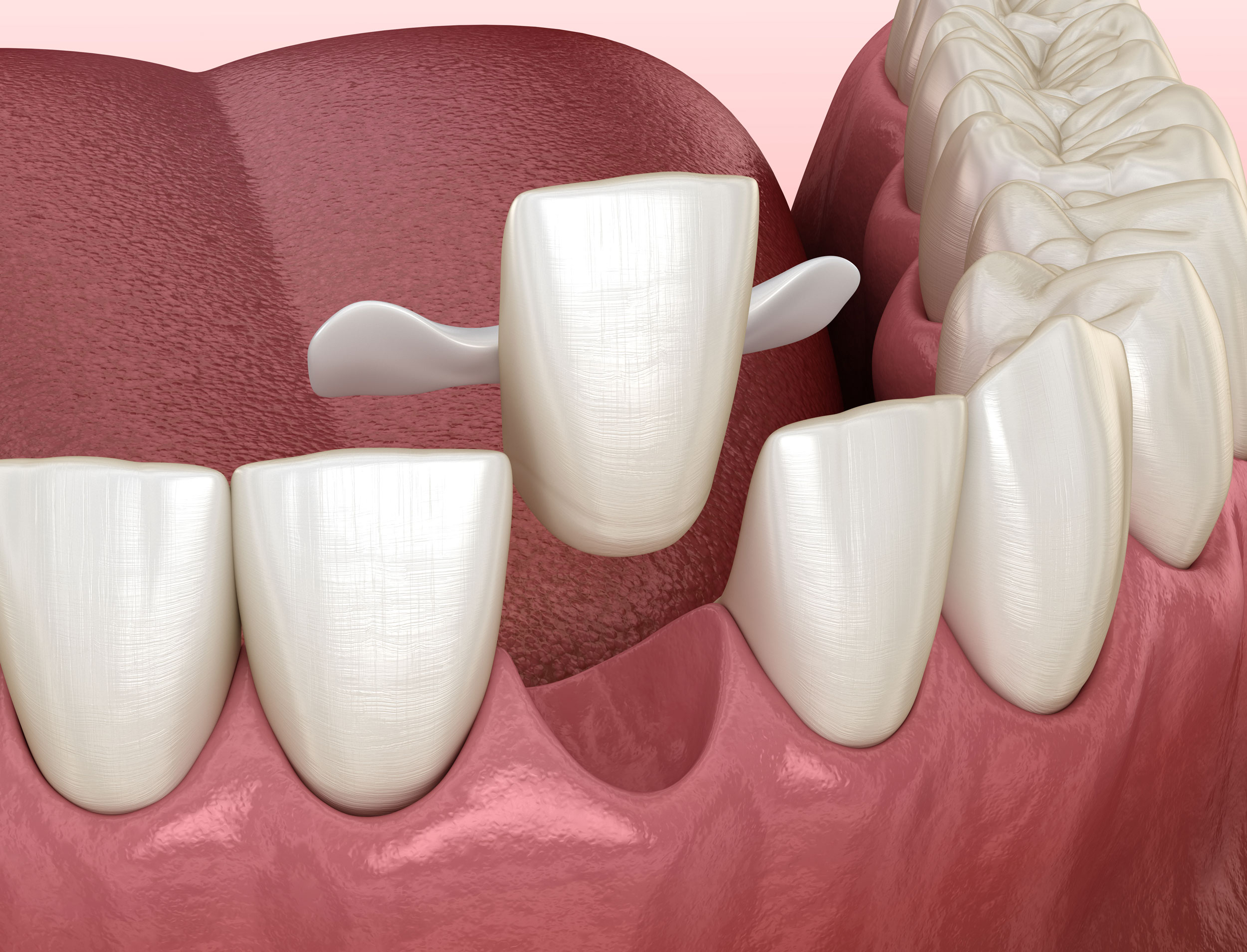 Tooth Bridge Specialist Care Singapore
