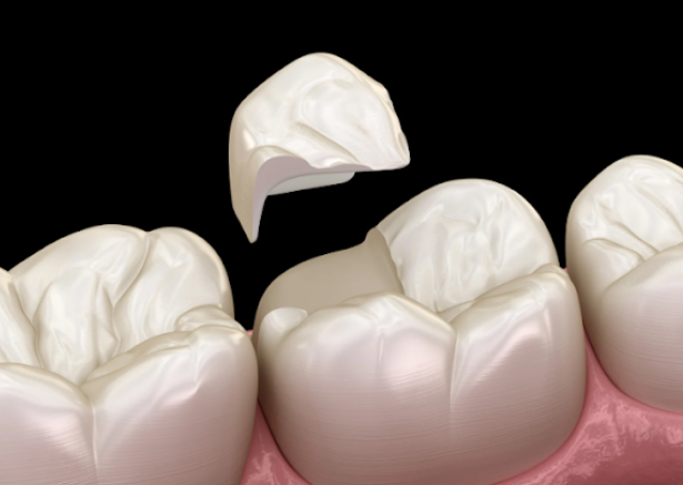 Do You Need A Root Canal After A Filling?