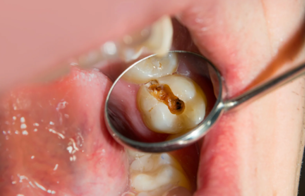 Cracked Tooth Treatment for Athletes: How to Protect Your Smile on the Field
