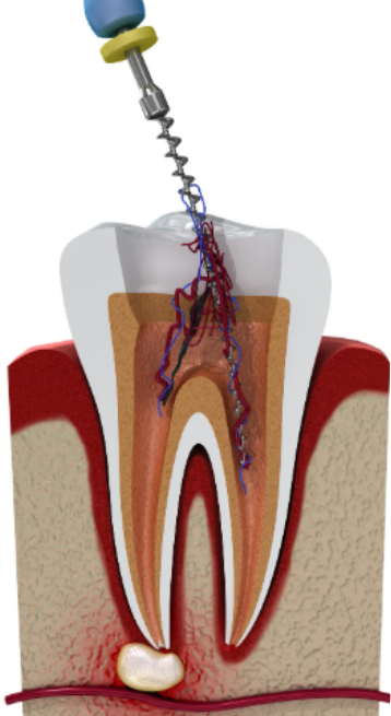 root canal