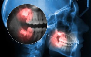 Wisdom Tooth Removal in Singapore: Tips for a Smooth and Speedy Recovery