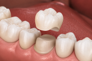 Dental Crown Replacement