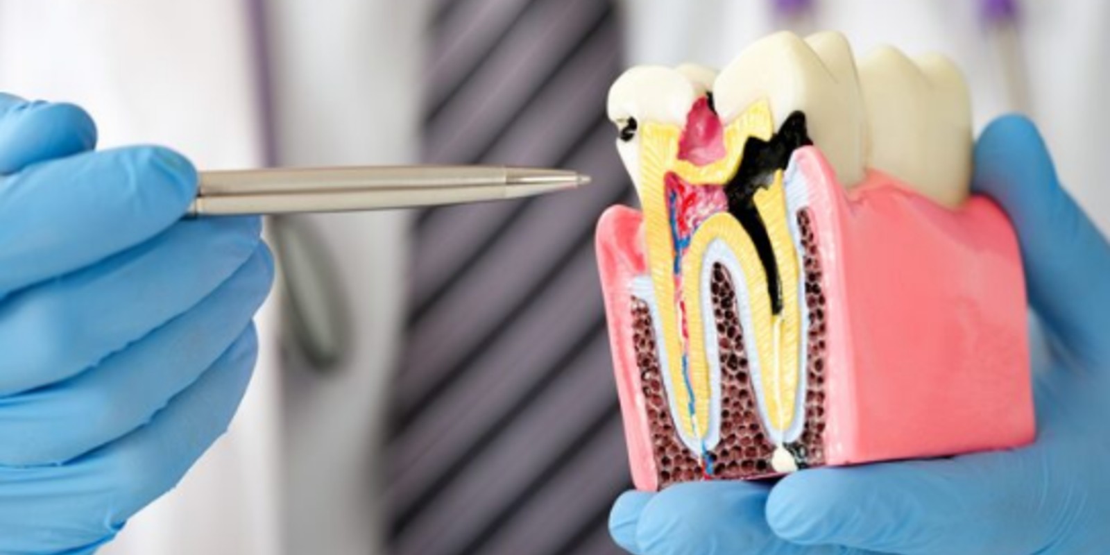 Root canal retreatment procedure