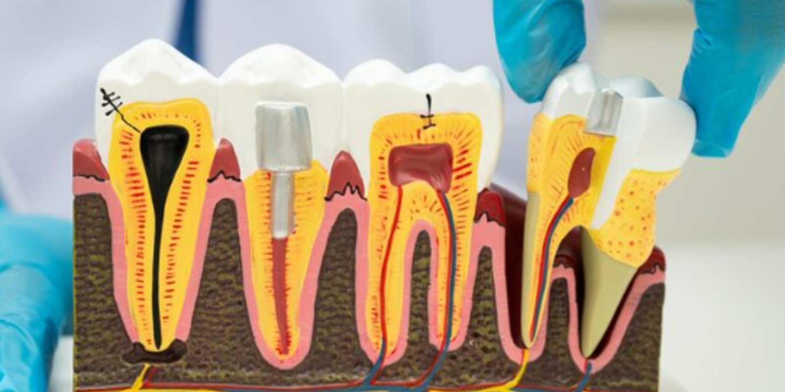 Root canal and apicoectomy comparison