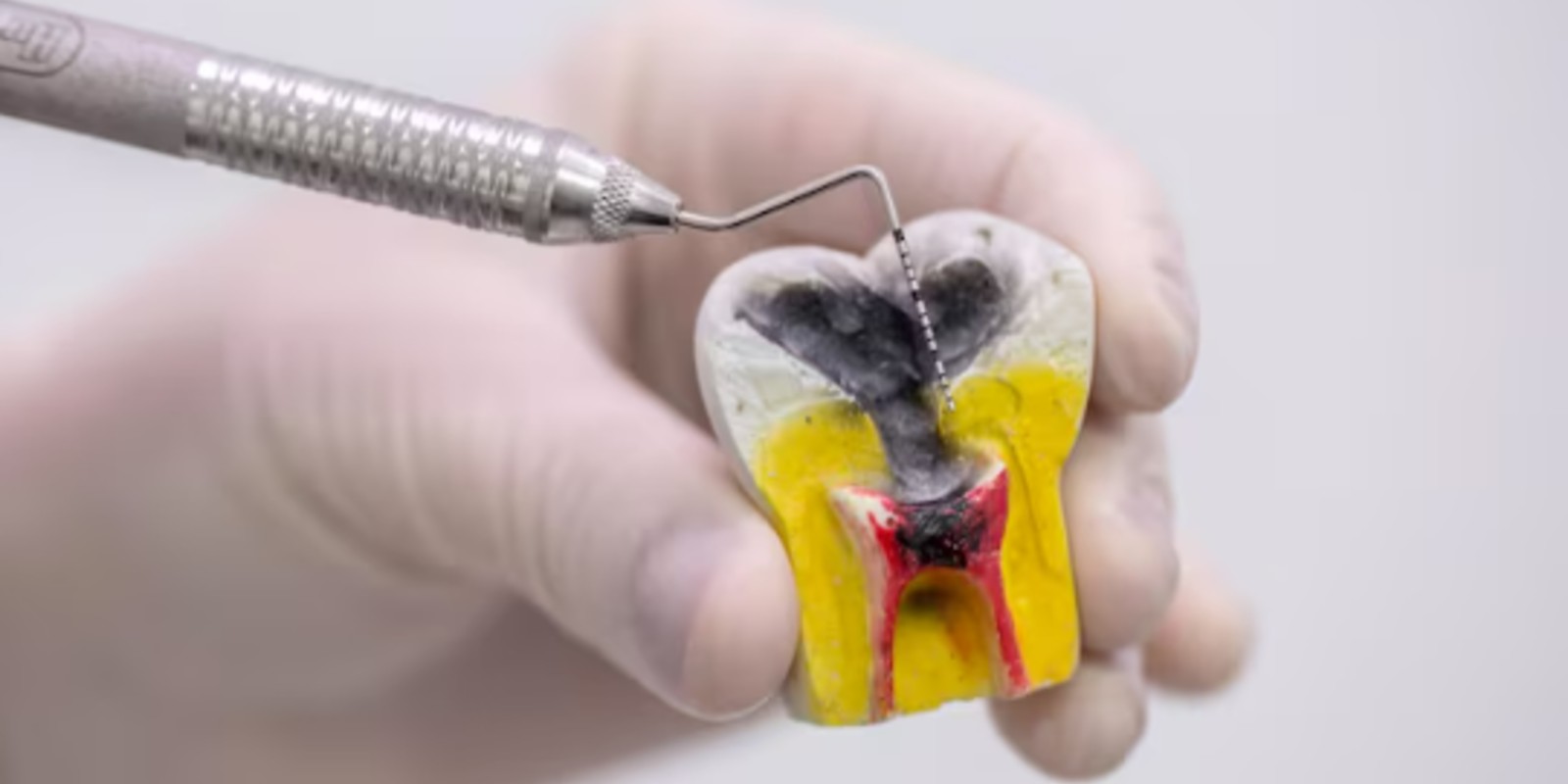 Signs of failed root canal treatment